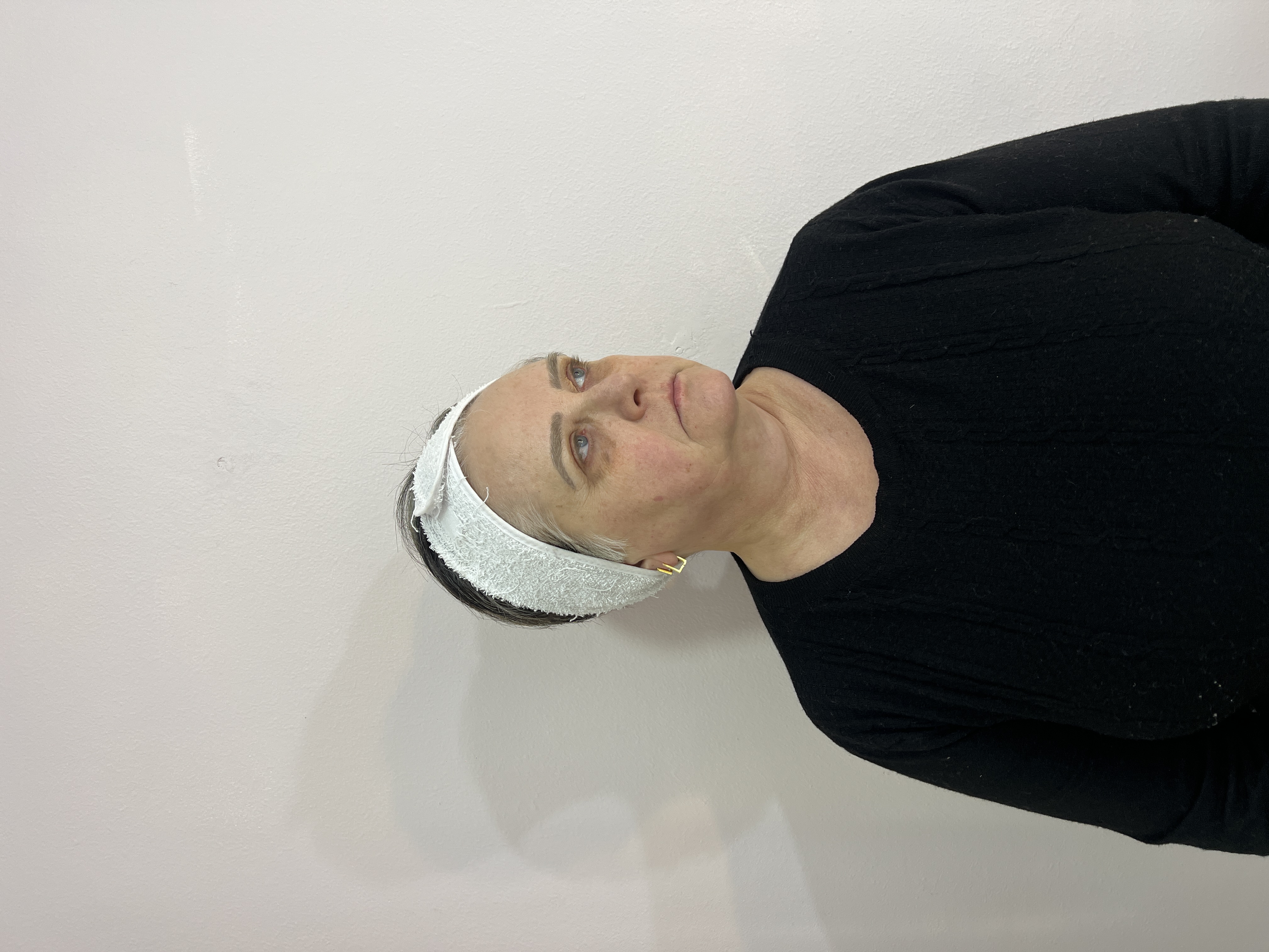 Paciente antes da harmonização facial - lado esquerdo